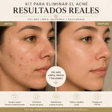 Cargar imagen en el visor de la galería, Antes y después del kit para piel grasa e imperfecciones mostrando resultados en la piel más limpia y saludable.