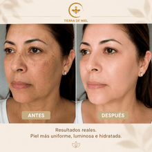 Cargar imagen en el visor de la galería, Comparativa de piel antes y después usando kit quita manchas facial, mostrando resultados reales y mejoría en la luminosidad.