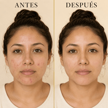 Cargar imagen en el visor de la galería, Comparativa antes y después del uso del jabón de miel y propóleo para imperfecciones en la piel.
